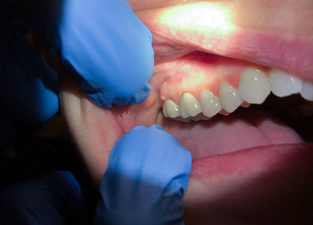 Best Urgent Care for Lost Fillings or Crowns in Plover, WI